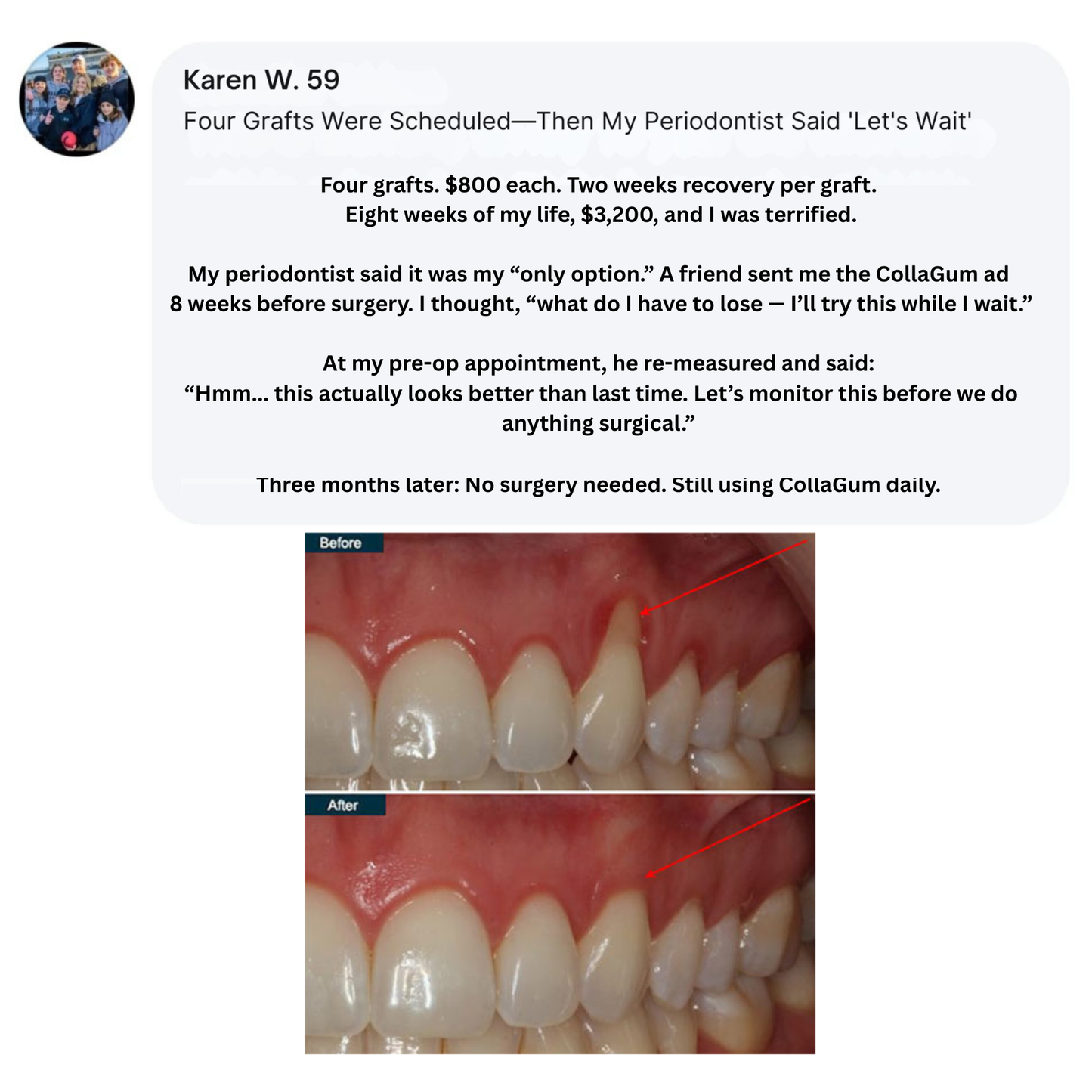 Nudent Gingival Maritime Collagen — Encías retraídas y regeneración del tejido