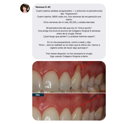 Nudent Gingival Maritime Collagen — Encías retraídas y regeneración del tejido
